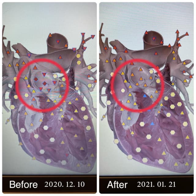 メタトロン ホリスティック 〜未来の人間ドック!先端テクノロジー装置「メタトロン」による健康管理〜の採用する4Dメタトロンによるメタセラピー事例① 心臓